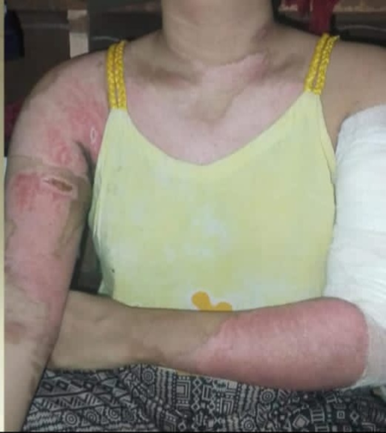 Luka bakar melepuh akibat penyiraman air panas yang di alami Ana Fitria sebagai korban (Foto: Dok kjn/okejatim/monirt)